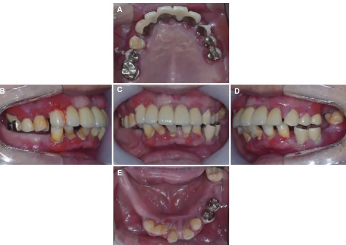 Fig. 1. Intra-oral status in the initial examination. Generalized chronic periodontitis was shown