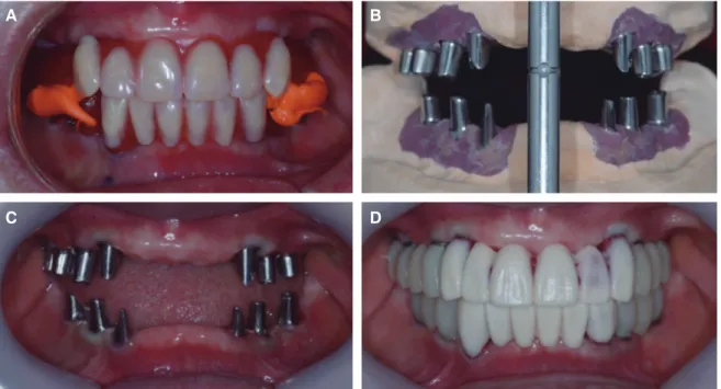 Fig. 9. (A) Esthetic try-in for evaluation and fabrication of customized abutment, (B) Customized abutment fabrication,  (C) Placement of customized abutment by repositioning jig, (D) Wax mock up try-in.