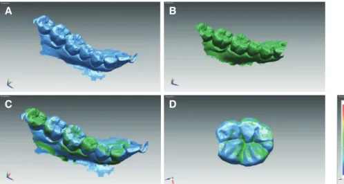 Fig. 1. Deviation analysis procedure. (A) Scanned 3-dimensional images of  target tooth at baseline (1 week), (B) Scanned 3-dimensional images of target  tooth after 6 months, (C) Superimposed image of target tooth from 1 week  and 6 months by Rapidform al