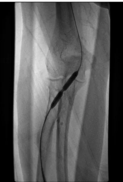 Fig. 2. Despite the use of balloon angioplasty, it can be difficult  to dilate the stenosis