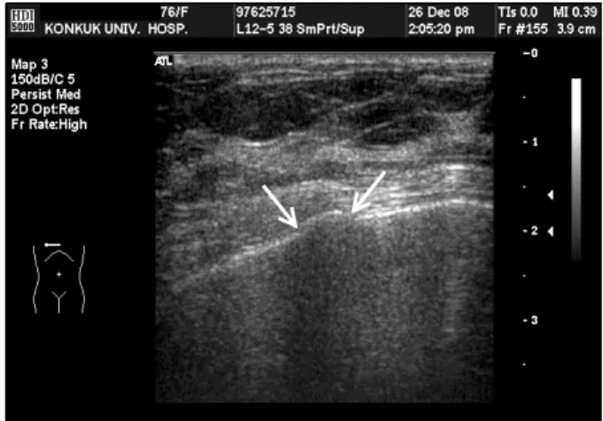 Fig. 2. Chest wall sonogram of 33-year-old woman with fist injury  showing sternum fracture