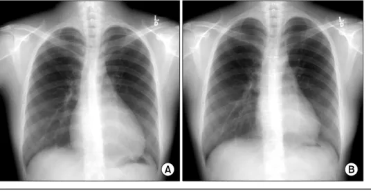 Fig. 1. (A) Preoperative chest  x-ray, (B) Postoperative 6 months  chest x-ray.