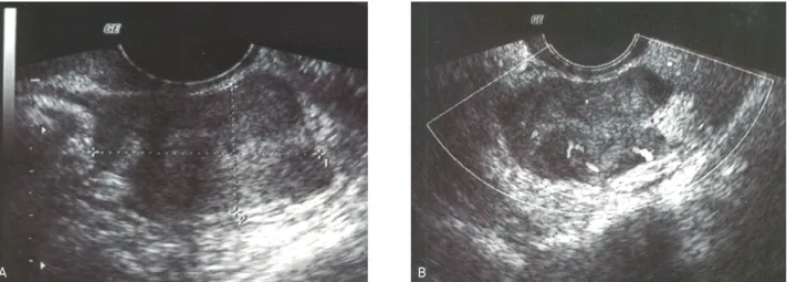 Fig. 1. Showed the echogenic mass (4.1×3.9×2.8 cm) (A) with blood flow (B) in cul-de-sac.술을 시행 받았다