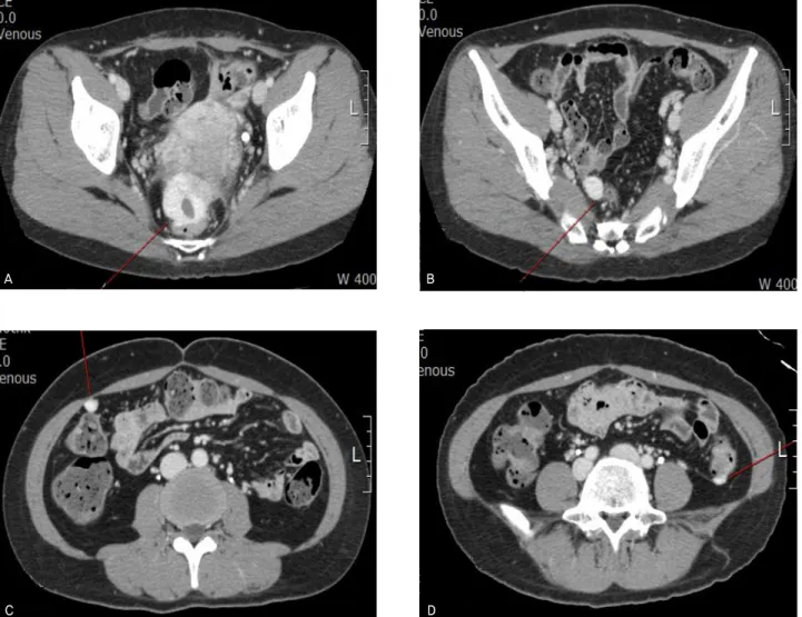 Fig. 2. Contrast-enhanced computed tomography image showed well enhanced masses in cul-de-sac (A) and on the surface of rectum (B), anterior abdominal wall (C), and descending colon (D).