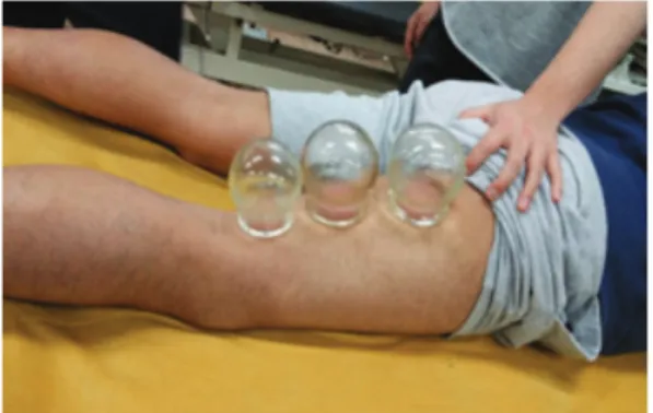 Fig. 2. Attachment point of cupping therapy