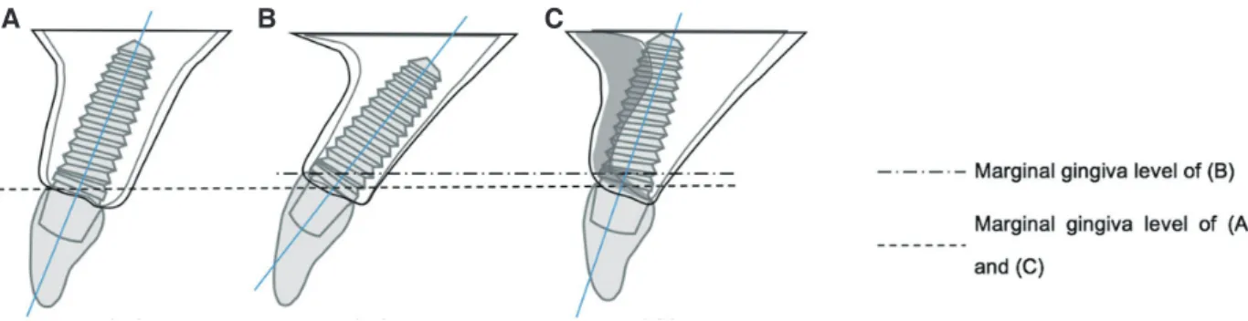 Fig. 2. (A) Intraoral photograph at first visit, (B) Periapical standard images at first visit.