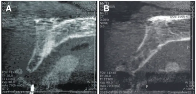 Fig. 4. Bone augmentation. (A) Narrow edentulous ridge of operation site: before operation, (B) Flap elevation: thin  width with palatal defect of alveolar bone, (C) After applying of bone graft material and Ti-mesh.