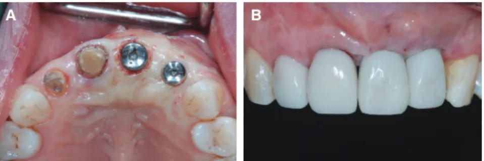 Fig. 8. After 2nd surgery using punch technique. (A) Intraoral image of operation site after connecting healing  abutment, (B) Front view of provisional restoration.