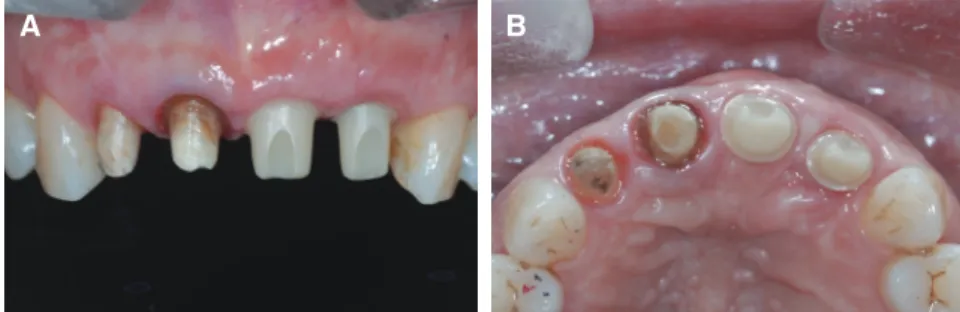 Fig. 13. Intraoral images after final setting with resin cement. (A) Frontal view, (B) Left lateral view.