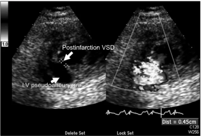 Fig. 1. Preoperative echocardiogram shows ventricular septal de-