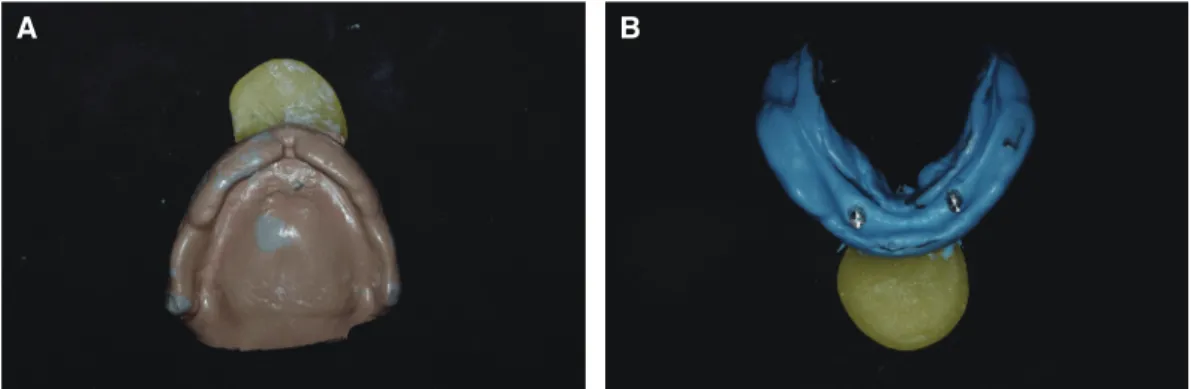 Fig. 4. Definitive impression for master cast. (A) Maxilla, (B) Mandible with impression coping.