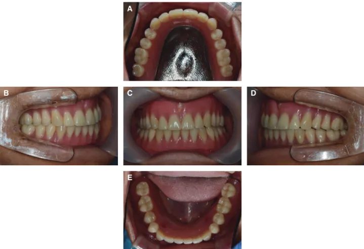 Fig. 7. Intraoral view of definitive dentures. All teeth contact evenly on centric relation.