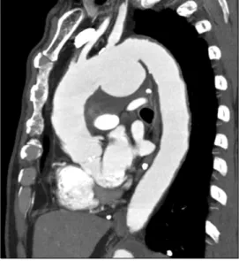 Fig. 1. Computed tomography shows saccular aneurysm with in- in-tramural thrombus in the aortic arch.