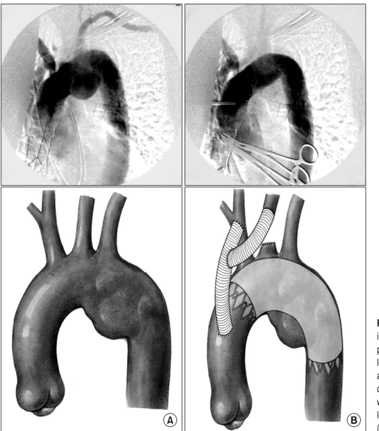 Fig. 2. The upper angiography find- find-ing showed endovascular stent graft  placement (before and after)