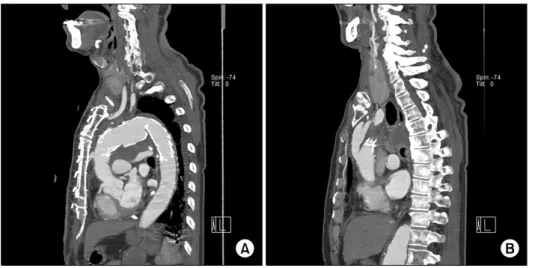 Fig. 3. Postoperative computer to- to-mography. These figures show the  complete coverage of aortic  aneur-ysm without endoleak (A) and  well-visualized Y-brached graft from  ascending aorta (B).