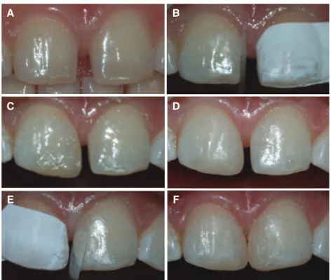 Fig. 4. (A) Preoperative photograph, (B) Postoperative photograph, (C) Follow-up after 3 months.
