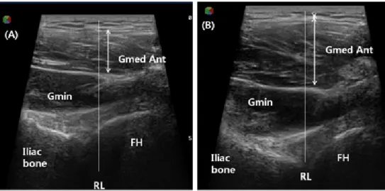 Fig. 3. Image of gluteus medius anterior fiber. A: Resting, B: Contraction, Gmed: gluteus medius,  Gmin: gluteus minimus, FH: femoral head, RL: reference line