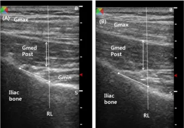 Fig. 4. Image of gluteus medius posterior fiber. A: Resting, B: Contraction, Gmax: gluteus maximus,  Gmed: gluteus medius, Gmin: gluteus minimus, RL: reference line