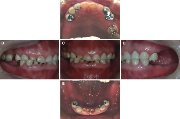 Fig. 1. Pre-treatment state. (A) Maxillary occlusal view, (B) Right lateral view, (C) Frontal view, (D) Left lateral view, (E)  Mandibular occlusal view.