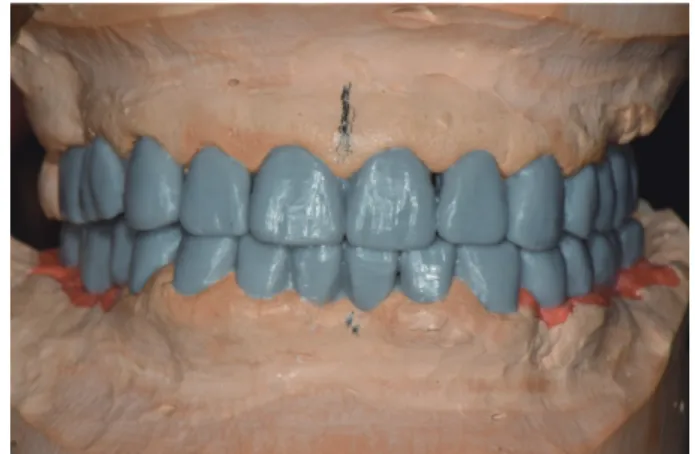 Fig. 4. Primary diagnostic wax-up. Fig. 5. Secondary diagnostic wax-up.