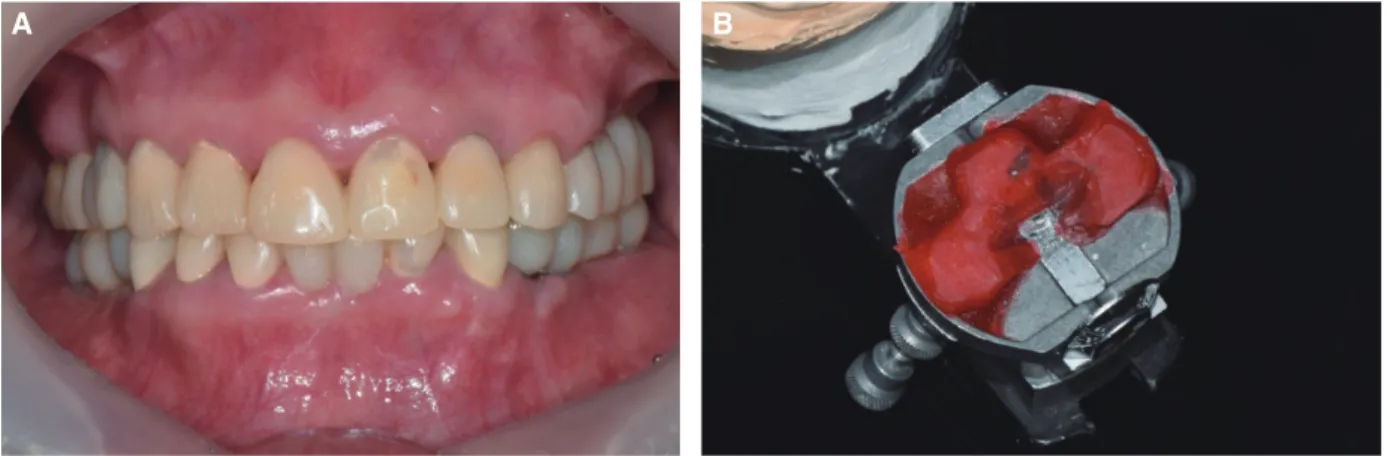 Fig. 7. Final prostheses delivery. (A) Maxillary occlusal view, (B) Right lateral view, (C) Frontal view, (D) Left lateral view, (E)  Mandibular occlusal view