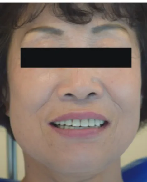 Fig. 8. Analysis of the smile line.  으로 적절한 전치유도가 재현되고 측방운동 시 구치부가  이개되는 상호 보호 교합을 확인하였다