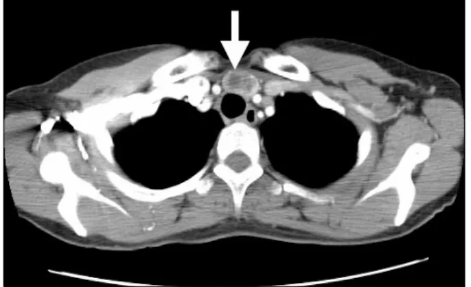 Fig. 1. Chest CT showing 3 cm sized well-marginated mass  (arrow) in midline portion of supero-anterior mediastinuum.