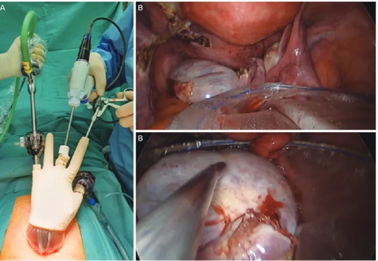 Fig. 2. Single-port laparoscopic surgical staging outside view (A) and safe tumor removal using a laparoscopic tissue retrieval bag (B, C)