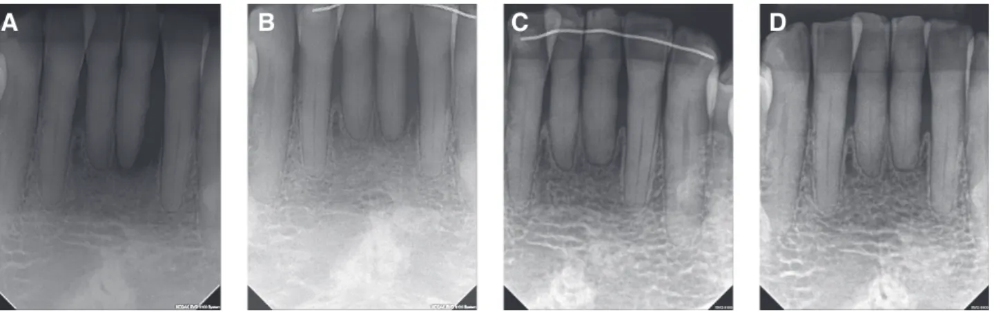 Fig. 3. Periapical radiography: (A) Initial radiography showing a severe bone loss of the both mandibular central  incisors, which have subgingival calculus deposition