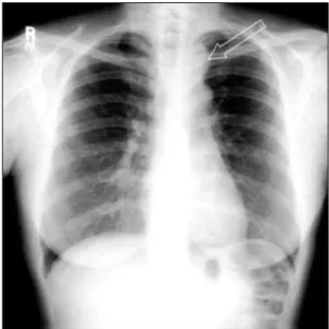 Fig. 2. Preoperative chest CT shows a well-defined mass in  the  posterior mediastinum.