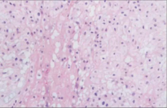 Fig. 5. Microscopic finding shows a chordoma which con- con-tained large tumor cells with clear cytoplasm (physaliferous),  mild nuclear pleomorphism and low-rate of mitoses (H &amp; E  stain, ×400).