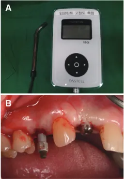 Fig 1.  (A)  Resonance  frequency  analyzer  (Osstell  Mentor ® ), (B) Wireless transducer (Smartpeg TM ,  Integration Diagnostics AB, Göteborg, Sweden)  connected to the implant.