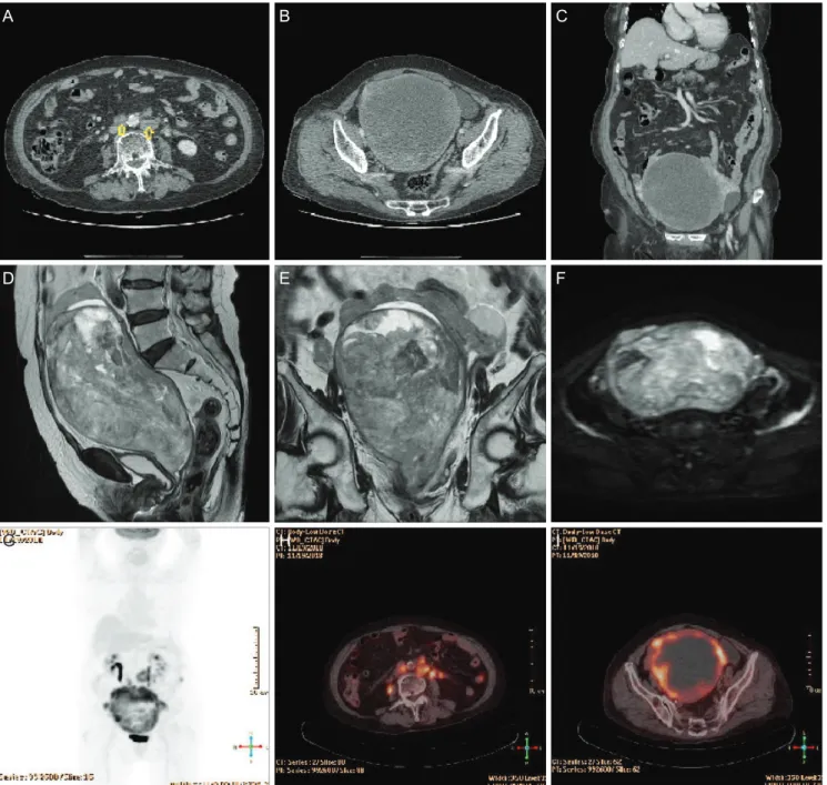 Fig. 1. Computed tomography ([A-C] with enlarged lymph nodes marked with yellow arrow)