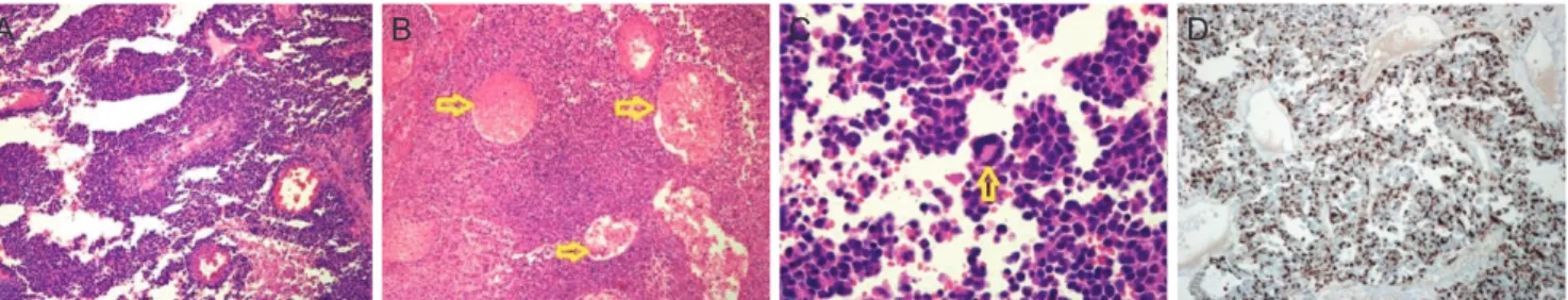 Fig. 2. Histopathology shows a papillary growth pattern and several necrotic spots (A; hematoxylin and eosin [H&amp;E], x100); poorly  differentiated cells with irregular alveolar spaces (yellow arrows, B) (H&amp;E, x40); multinucleated giant cells (yellow
