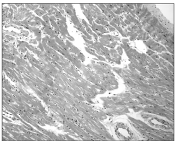 Fig. 2. Microscopic finding of the left ventricle shows the non  compacted layer surrounded by deep intertrabecular recesses  (H&amp;E ×100)
