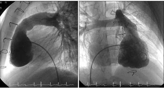 Fig. 3. Follow-up right ventricular  angiogram (27 months after  ope-ration) (Left; lateral view / Right; 