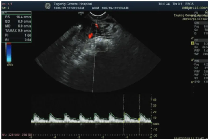 Fig. 2. Doppler indices of uterine artery (resistance index [RI] and  pulsatility index [PI]) and endometrial thickness in the bleeding  group before the insertion.