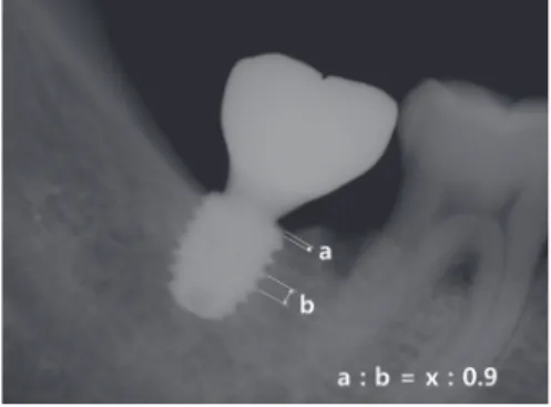 Fig. 2. Measurement of C/I ratio on periapical radiograph, (A) Control  group: CMI IS-III active® diameter 5 mm × length 10 mm, (B)  Experi-mental group: CMI IS-III active® diameter 5.5 mm × length 6.6 mm