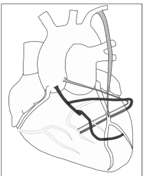 Fig. 2. New arterial graft was anastomosed in a double Y config- config-uration to the patent in situ LITA, which was previously  anasto-mosed to the LAD