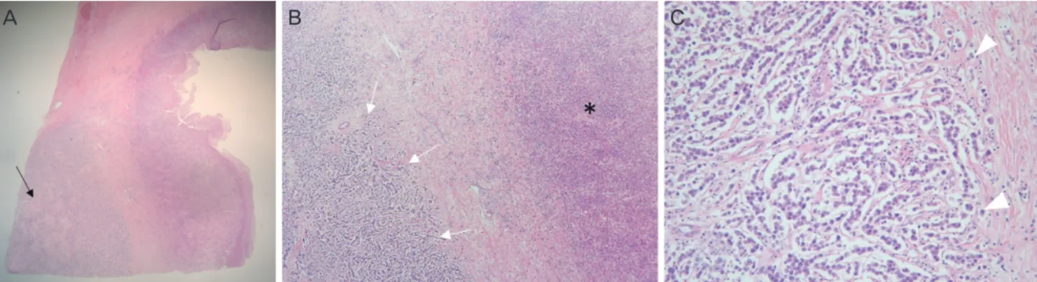 Fig. 1. Abdomino-pelvic computed tomography. (A) Axial view showing a large (10 cm) right ovarian tumor (arrow) with internal necrosis,  possibly complicated by colo-ovarian fistula and associated pelvic inflammatory disease