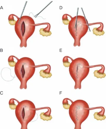 Fig. 1. Single-port laparoscopic myomectomy (LM) with a modi- modi-fied suture technique with a Hem-o-lok clip (Choi’s LM)