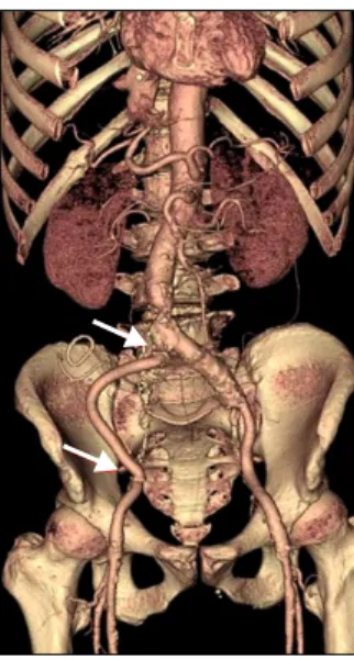 Fig. 3. Postoperative abdominal CT scan shows in situ interposi- interposi-tion of 8 mm artificial graft.