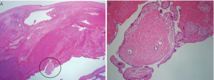 Fig. 2. Histological finding of oophorectomy_chorionic villi tissues in the wall of ovary, high magnification (×40) (A) and low magnifica- magnifica-tion (×100) (B).
