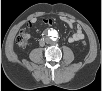 Fig. 1. Preoperative computed tomography demonstrated infrarenal  abdominal aortic aneurysm measured 55.71 mm.