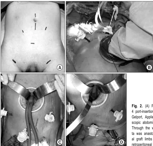 Fig. 2. (A) Preoperative incision marking. There are  4 port-insertion sites. (B) By using a Gelport (Applied  Gelport, Applied medical., USA) Hand-assisted  laparo-scopic abdominal aortic dissection was performed
