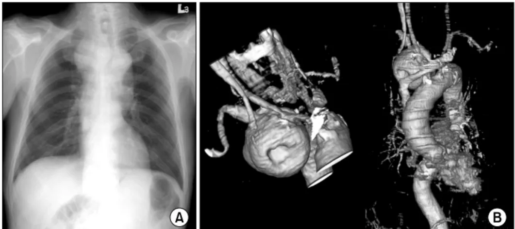 Fig. 2. Postopertive CT angiography shows graft interposition be- be-tween innominate artery and right common carotid artery with 