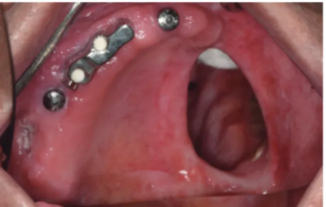 Fig. 4. Two weeks after removal of failed implant of  maxillary right molars.