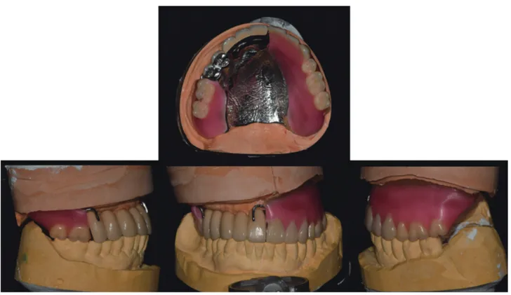 Fig. 11. Arrangement of artificial teeth.