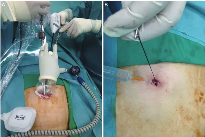 Fig. 1. Umbilical infiltration of local anesthesia while single-port access (SPA) laparoscopic surgery