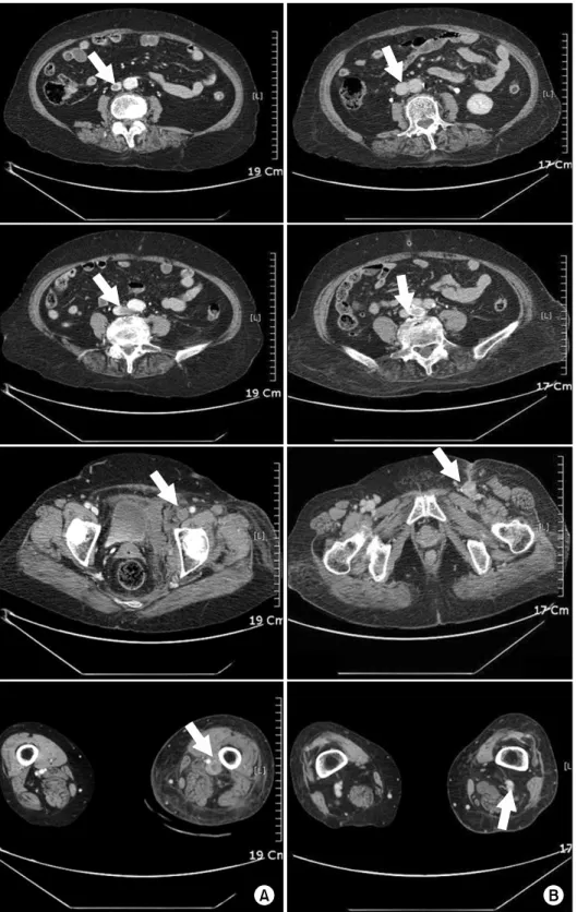 Fig. 1. (A) Computed tomographic  findings of the first case showing  intraluminal thrombus from inferior  vena cava to popliteal vein (white  arrows) and left iliac vein  compre-ssed by vertebral body and aortic  bifurcation